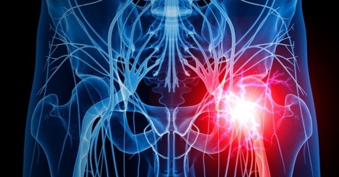 Sciatica