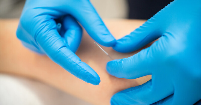 Trigger Point Dry Needling