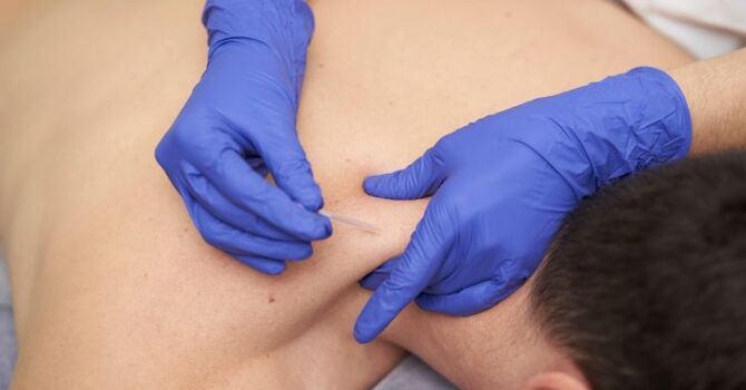 How Dry Needling Helps Athletes Recover from Overuse Injuries